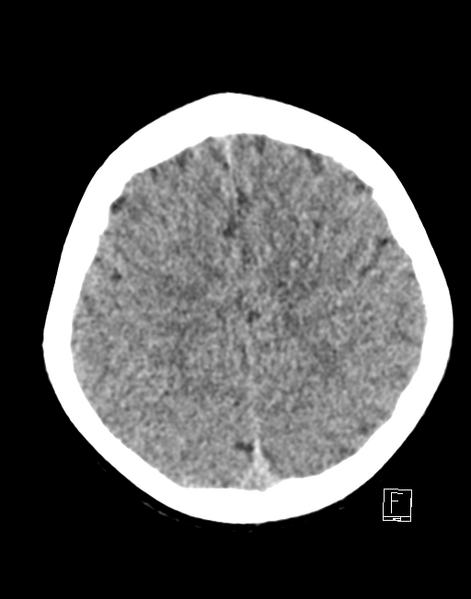 File:Cerebellar stroke (Radiopaedia 32202-33149 Axial non-contrast 23).png