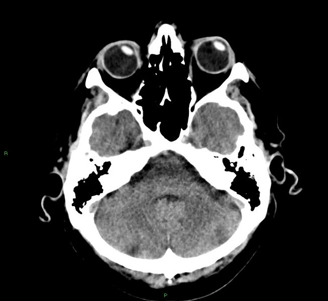File:Cerebral amyloid angiopathy-associated lobar intracerebral hemorrhage (Radiopaedia 58376-65511 Axial non-contrast 43).jpg