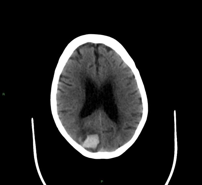 File:Cerebral amyloid angiopathy-associated lobar intracerebral hemorrhage (Radiopaedia 58377-65514 Axial non-contrast 19).jpg