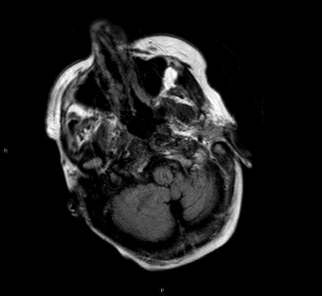 File:Cerebral amyloid angiopathy-associated lobar intracerebral hemorrhage (Radiopaedia 58377-65515 Axial FLAIR 23).jpg
