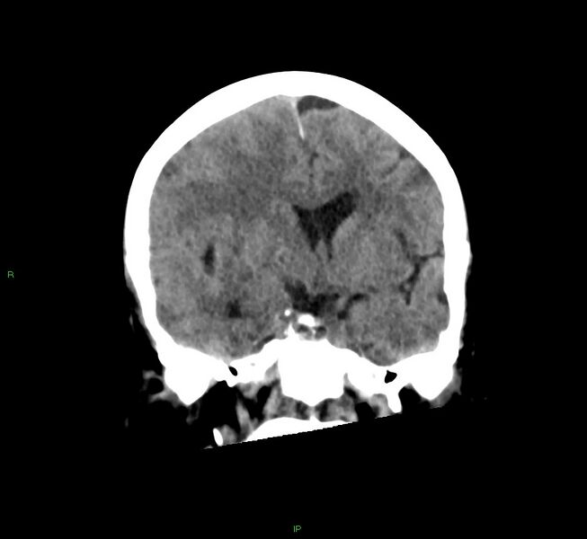File:Cerebral amyloid angiopathy-associated lobar intracerebral hemorrhage (Radiopaedia 58563-65727 Coronal non-contrast 39).jpg