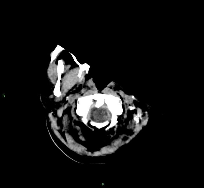 File:Cerebral amyloid angiopathy-associated lobar intracerebral hemorrhage (Radiopaedia 58566-65730 Axial non-contrast 48).jpg
