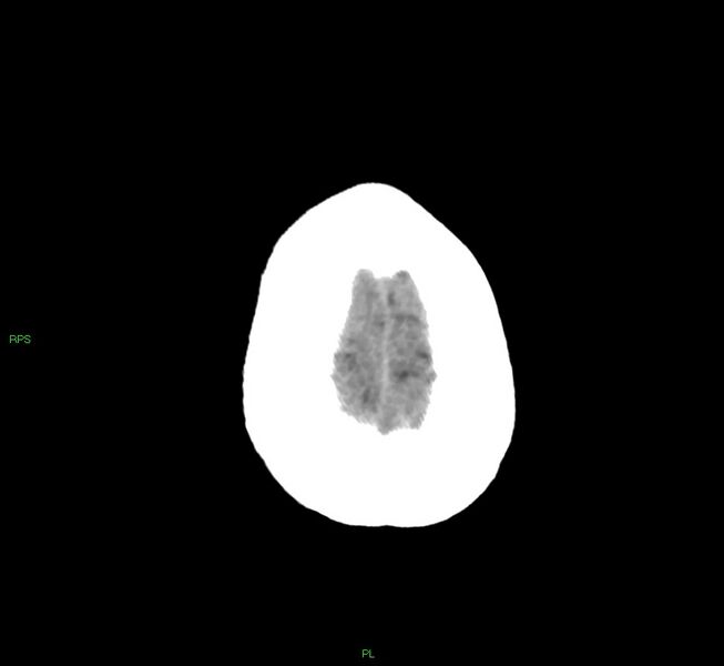 File:Cerebral amyloid angiopathy-associated lobar intracerebral hemorrhage (Radiopaedia 58569-65734 Axial non-contrast 12).jpg