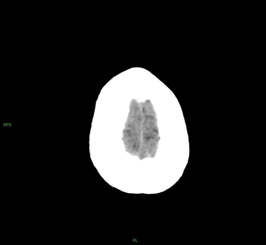 Cerebral amyloid angiopathy-associated lobar intracerebral hemorrhage (Radiopaedia 58569-65734 Axial non-contrast 12).jpg