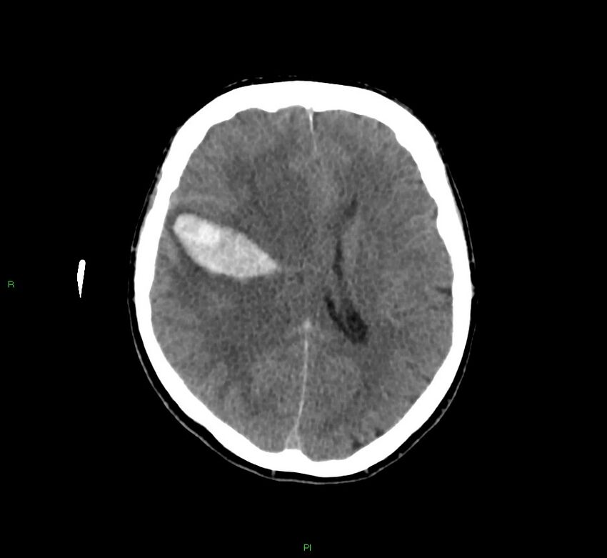 Cerebral amyloid angiopathy-associated lobar intracerebral hemorrhage (Radiopaedia 58756-65977 Axial non-contrast 24).jpg