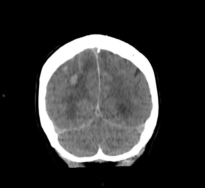 File:Cerebral amyloid angiopathy-associated lobar intracerebral hemorrhage (Radiopaedia 58756-65977 Coronal non-contrast 19).jpg