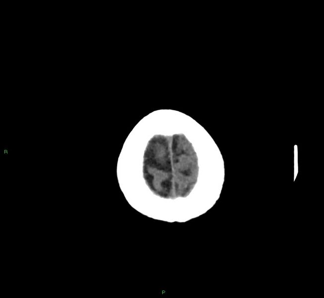 File:Cerebral amyloid angiopathy-associated lobar intracerebral hemorrhage (Radiopaedia 58757-65978 Axial non-contrast 6).jpg