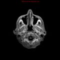 Cerebral and orbital tuberculomas (Radiopaedia 13308-13311 Axial T1 C+ 1).jpg