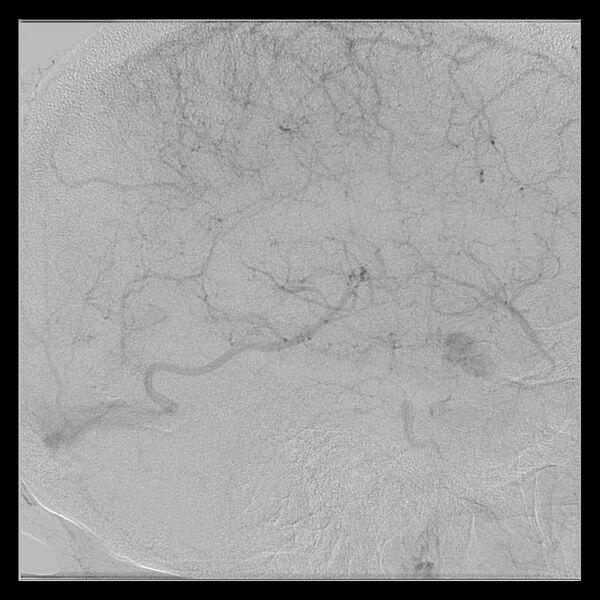 File:Cerebral aneurysm with rupture (Radiopaedia 29933-30458 LT ICA IC 47).jpg