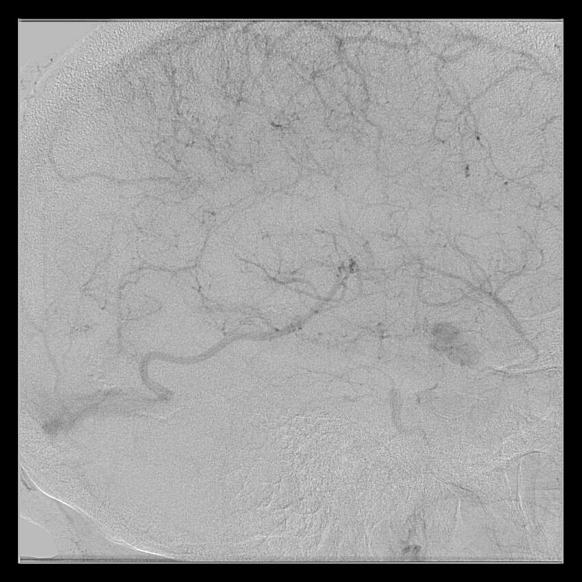 Cerebral aneurysm with rupture (Radiopaedia 29933-30458 LT ICA IC 47).jpg