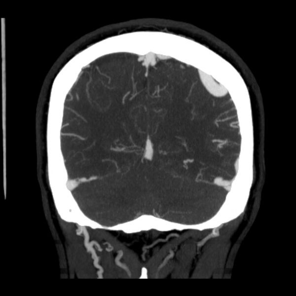 File:Cerebral arteriovenous malformation (Radiopaedia 43729-47189 C 37).jpg