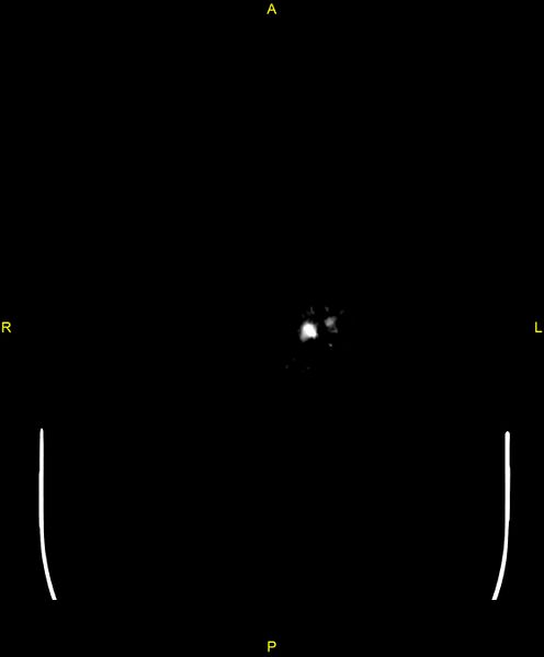 File:Cerebral autosomal dominant arteriopathy with subcortical infarcts and leukoencephalopathy (CADASIL) (Radiopaedia 86108-102051 Axial non-contrast 124).jpg