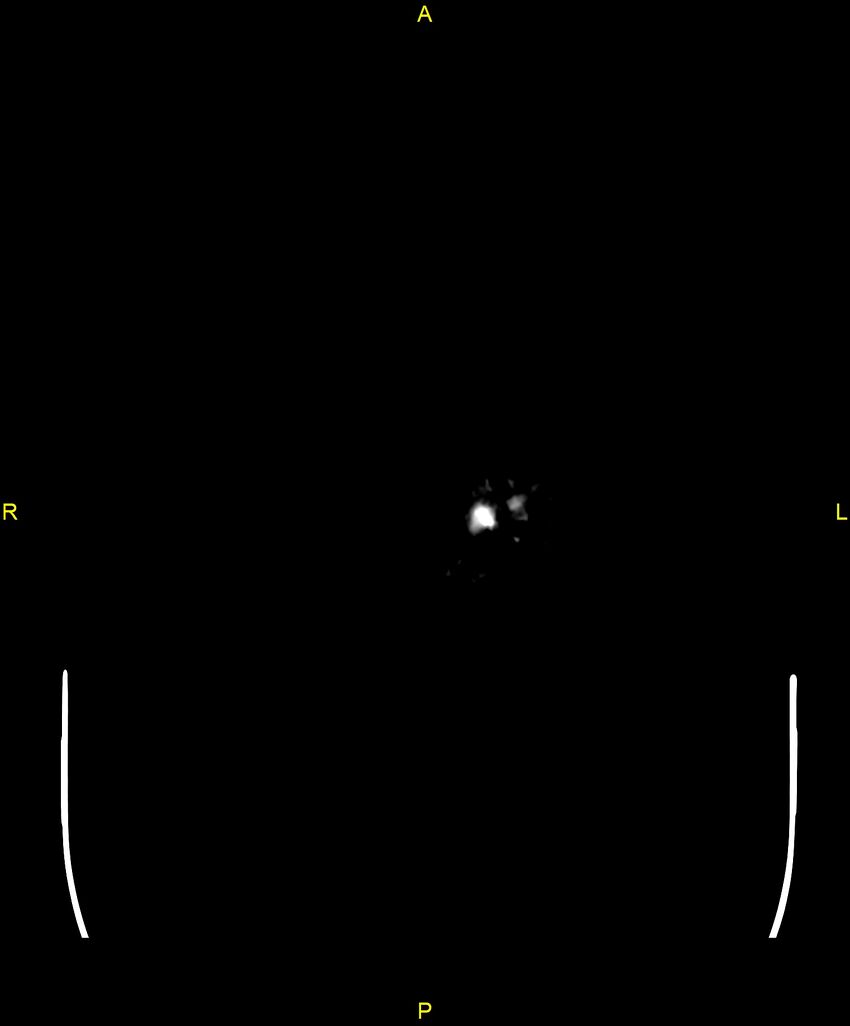 Cerebral autosomal dominant arteriopathy with subcortical infarcts and leukoencephalopathy (CADASIL) (Radiopaedia 86108-102051 Axial non-contrast 124).jpg