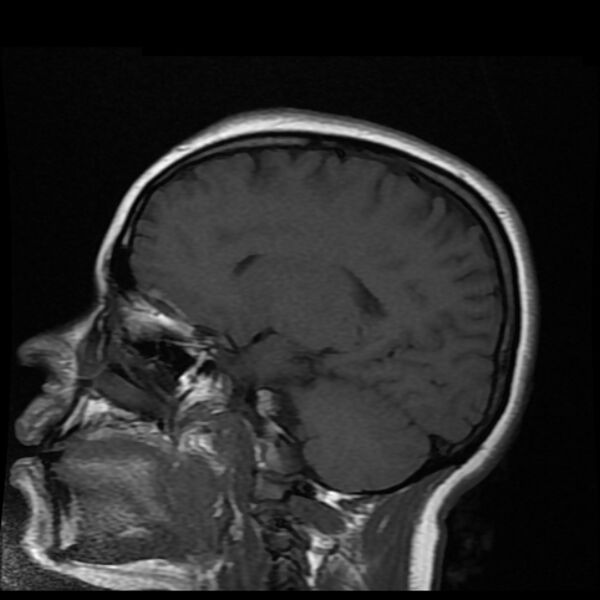 File:Cerebral cavernous malformation (Radiopaedia 44301-47942 Sagittal T1 13).jpg