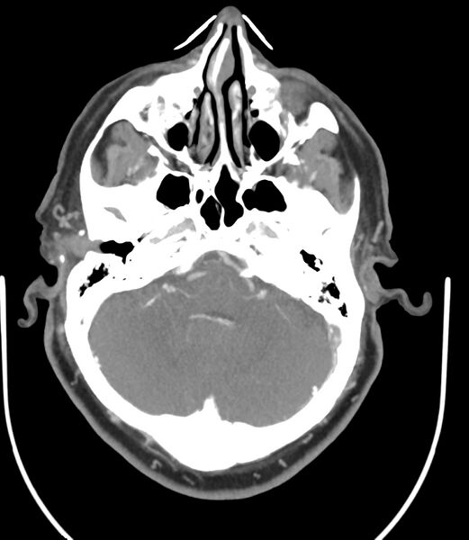 File:Cerebral dural venous sinus thrombosis (Radiopaedia 86514-102576 A 35).jpg