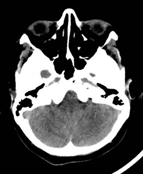File:Cerebral edema due to severe hyponatremia (Radiopaedia 89826-106937 Axial non-contrast 18).jpg