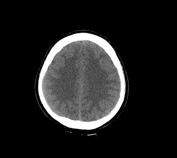 File:Cerebral fat embolism (Radiopaedia 37510-39362 Axial non-contrast 24).jpg