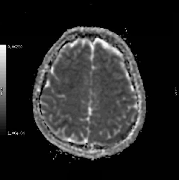 File:Cerebral fat embolism (Radiopaedia 37510-39363 Axial ADC 1).jpg