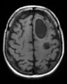 Cerebral metastases - small cell lung cancer (Radiopaedia 3972-6521 E 1).jpg