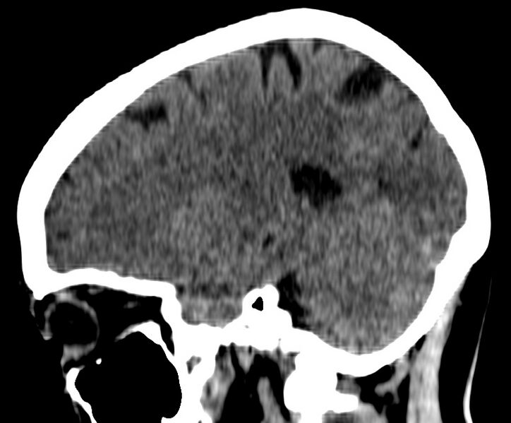 File:Cerebral venous thrombosis - CT only (Radiopaedia 41031-43778 B 27).jpg