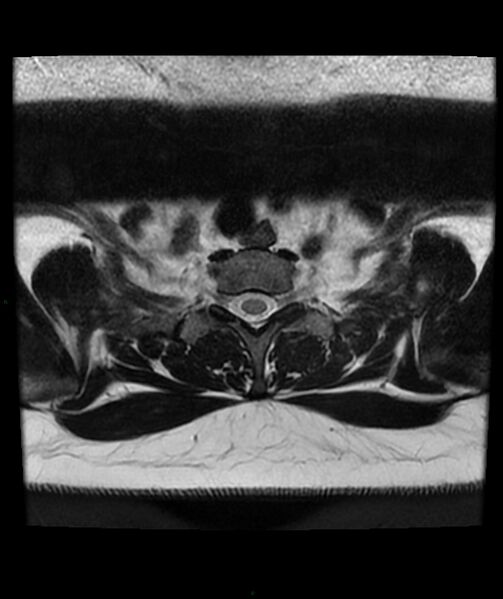 File:Cervical disc prolapse (Radiopaedia 80258-93598 Axial T2 89).jpg