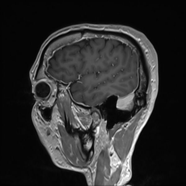File:Cervical dural CSF leak on MRI and CT treated by blood patch (Radiopaedia 49748-54995 G 9).jpg