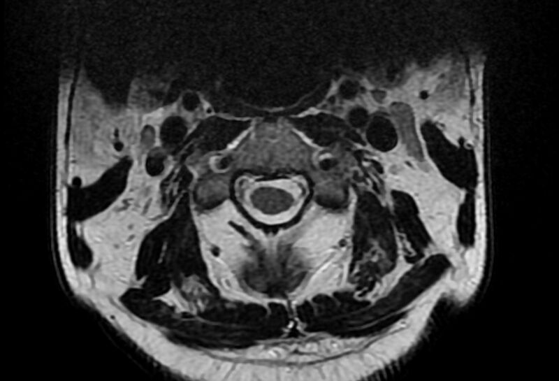 File:Cervical schwannoma (Radiopaedia 72399-82934 Axial T2 3).jpg