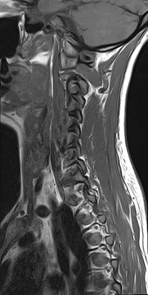 File:Cervical spondylodiscitis and calvarial hemangioma (Radiopaedia 64317-73104 Sagittal T1 3).jpg