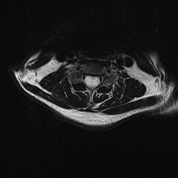 File:Cervical tumor-like myelopathy due to Type V dAVF (Radiopaedia 82461-96604 Axial T2 20).jpg