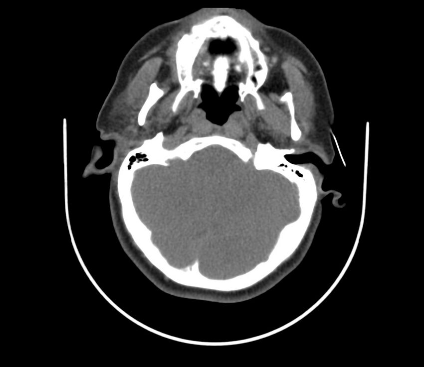 Cervical venous malformation (Radiopaedia 22653-22672 Axial non-contrast 15).jpg