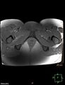 Cesarian scar endometriosis (Radiopaedia 68495-78066 Axial T1 fat sat 26).jpg