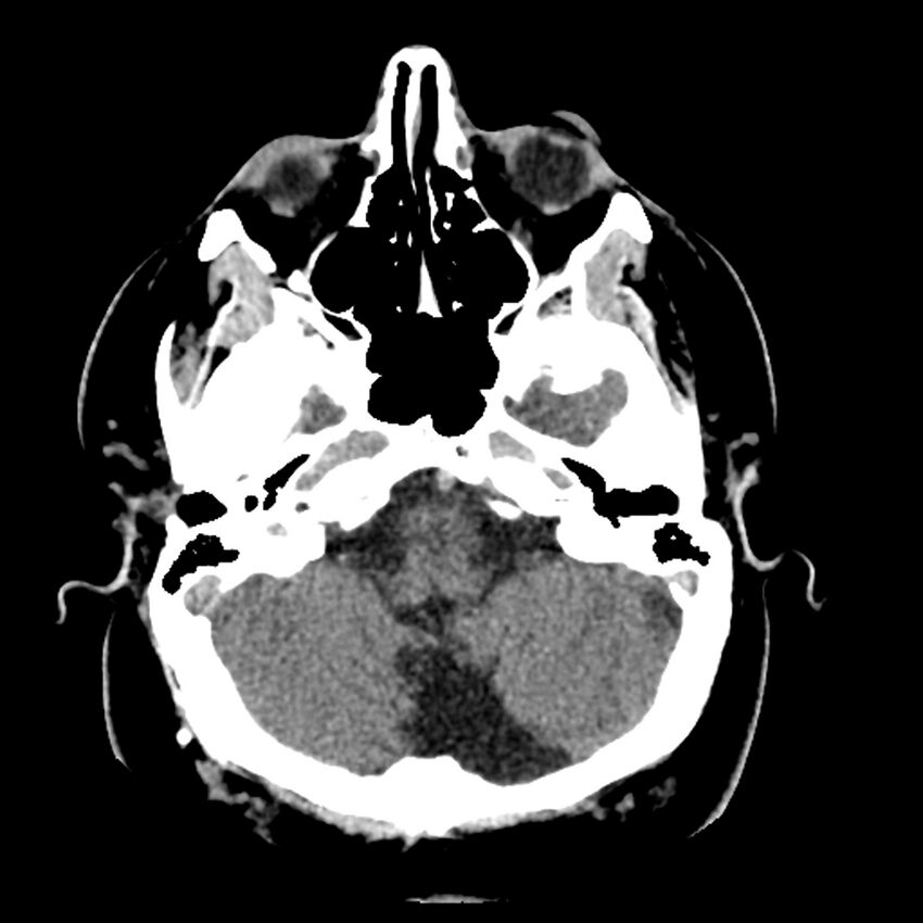 Chiasmatic-hypothalamic juvenile pilocytic astrocytoma (Radiopaedia 78533-91237 Axial non-contrast 14).jpg
