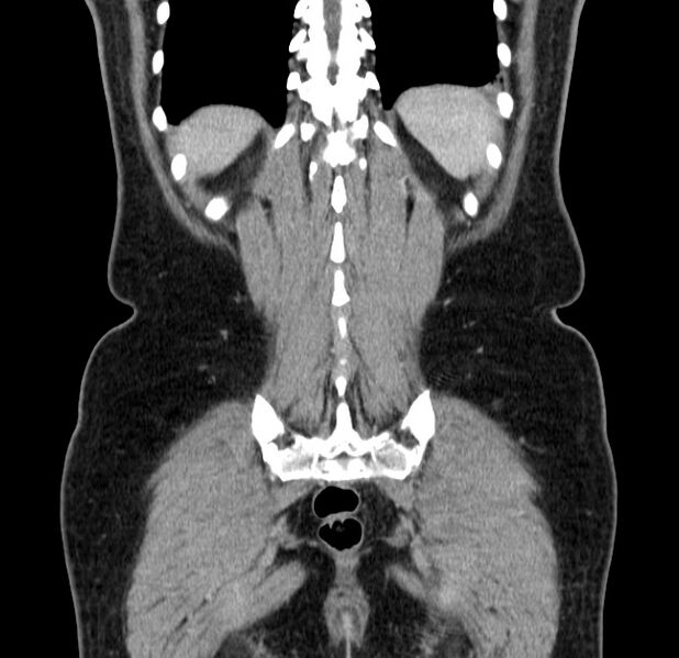 File:Choledocholithiasis on CT and MRI (Radiopaedia 24825-25087 C 45).jpg