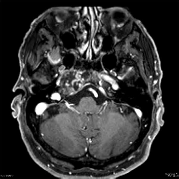 File:Chondrosarcoma of skull base- grade II (Radiopaedia 40948-43654 Axial T1 C+ 12).jpg