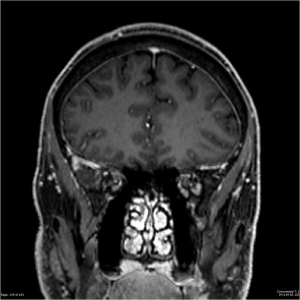 File:Chondrosarcoma of skull base- grade II (Radiopaedia 40948-43654 Coronal T1 C+ 50).jpg