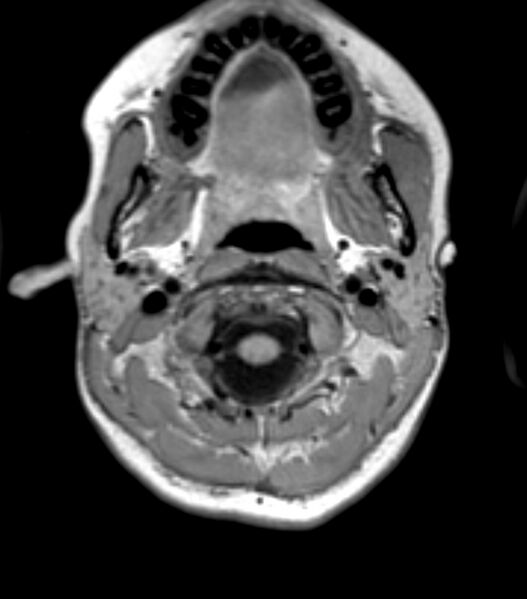 File:Choroid plexus carcinoma (Radiopaedia 91013-108553 Axial T1 23).jpg