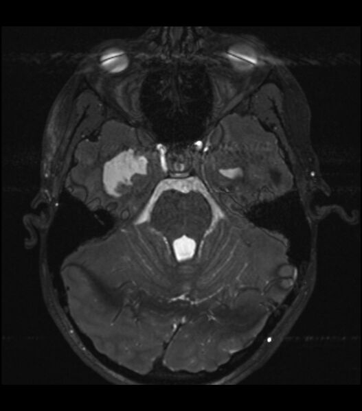 File:Choroid plexus carcinoma (Radiopaedia 91013-108553 Axial T2 CISS 3).jpg