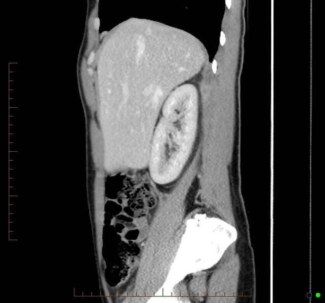 File:Chronic abscess due to "dropped" appendicoliths following appendectomy for perforated appendix (Radiopaedia 58805-66344 D 40).jpg