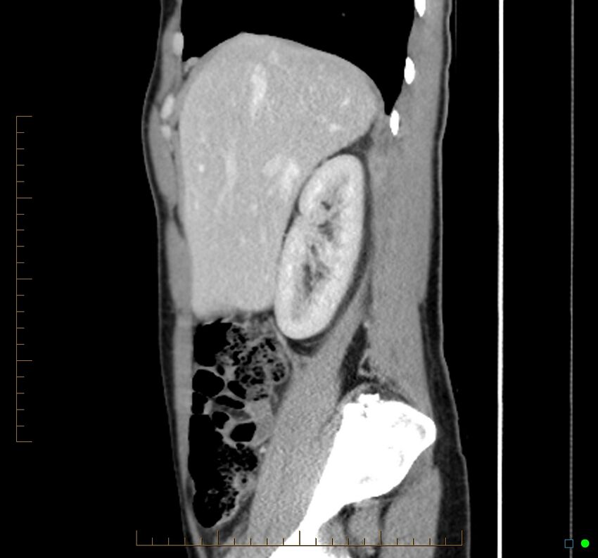 Chronic abscess due to "dropped" appendicoliths following appendectomy for perforated appendix (Radiopaedia 58805-66344 D 40).jpg