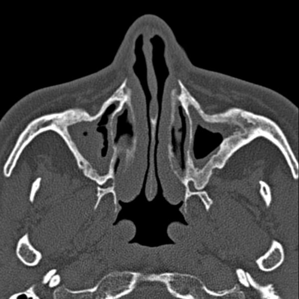 File:Chronic maxillary sinusitis (Radiopaedia 27879-28116 Axial bone window 15).jpg
