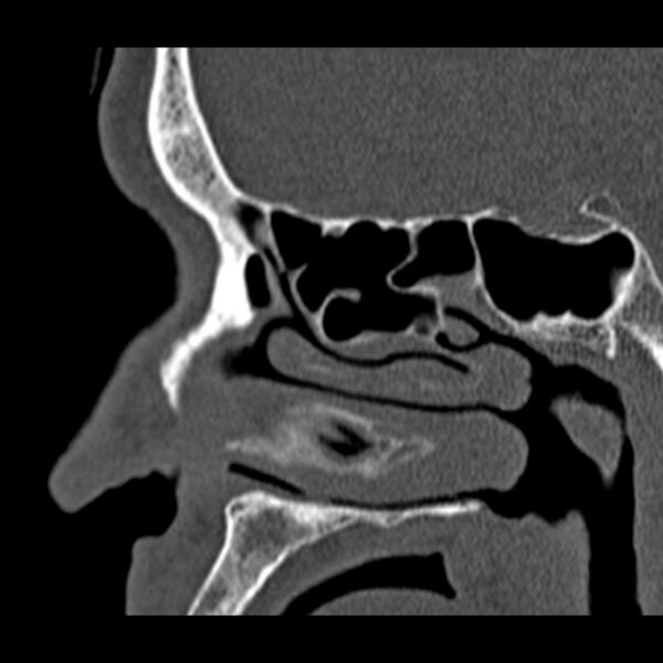 File:Chronic maxillary sinusitis (Radiopaedia 27879-28116 Sagittal bone window 33).jpg