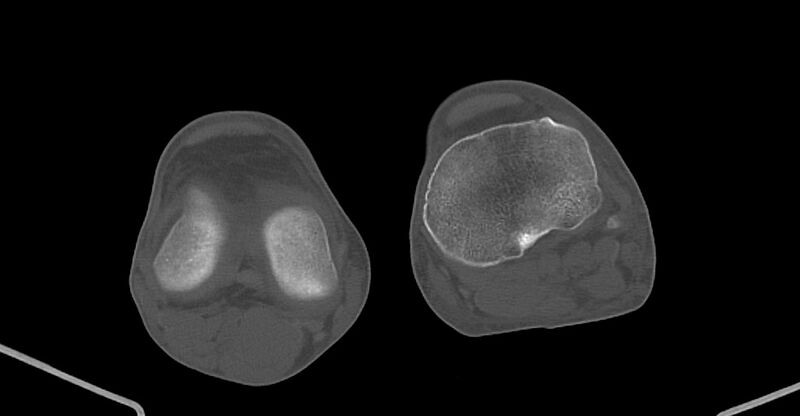 File:Chronic osteomyelitis (with sequestrum) (Radiopaedia 74813-85822 Axial non-contrast 194).jpg