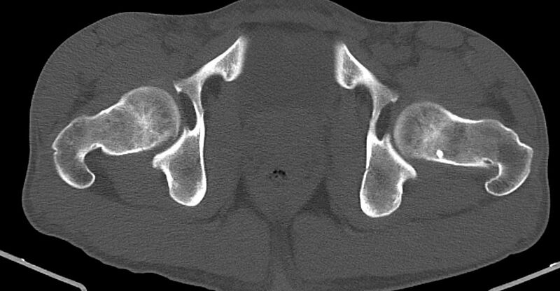 File:Chronic osteomyelitis (with sequestrum) (Radiopaedia 74813-85822 Axial non-contrast 42).jpg