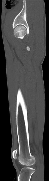 File:Chronic osteomyelitis (with sequestrum) (Radiopaedia 74813-85822 C 30).jpg