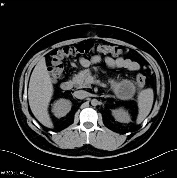 File:Chronic pancreatitis and pseudocysts (Radiopaedia 6724-7935 Axial non-contrast 10).jpg