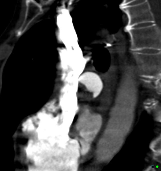 File:Chronic pulmonary embolism (Radiopaedia 17943-17702 Sagittal C+ CTPA 13).jpg