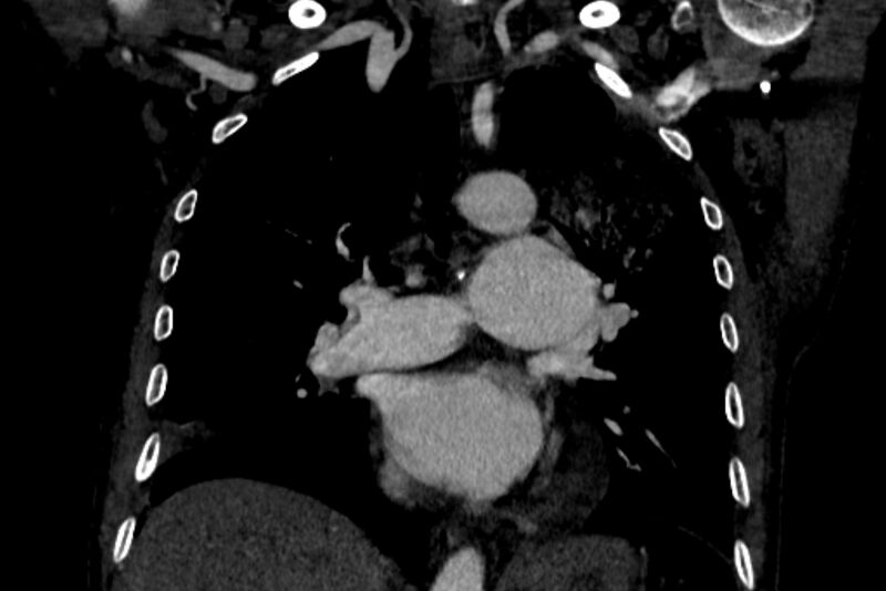 File:Chronic pulmonary embolism with bubbly consolidation (Radiopaedia 91248-108850 B 75).jpg
