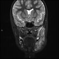 Chronic reactive multifocal osteomyelitis (CRMO) - mandible (Radiopaedia 56405-63069 Coronal STIR 16).jpg