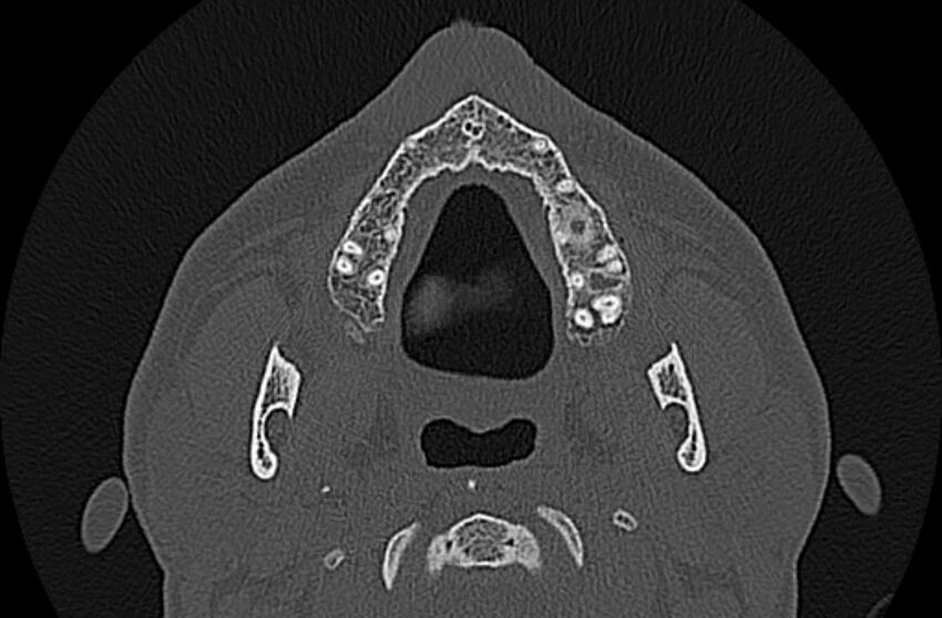 Chronic rhinosinusitis (Radiopaedia 65079-74075 Axial bone window 1).jpg