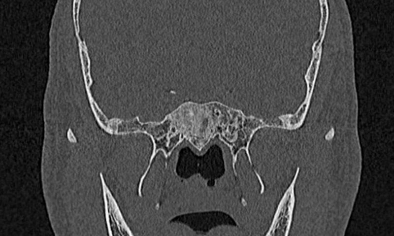 File:Chronic rhinosinusitis (Radiopaedia 65079-74075 Coronal bone window 74).jpg